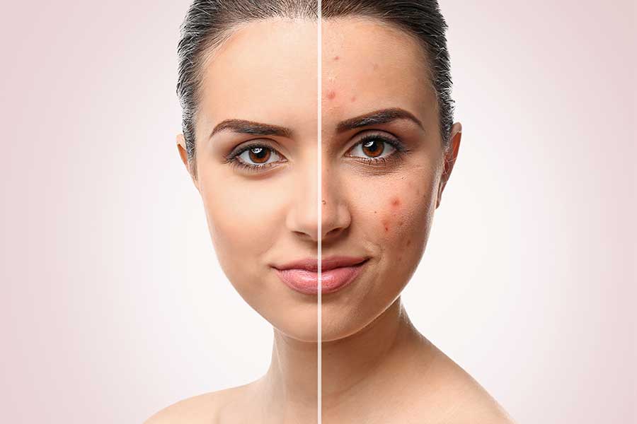 Before & After result of pico laser