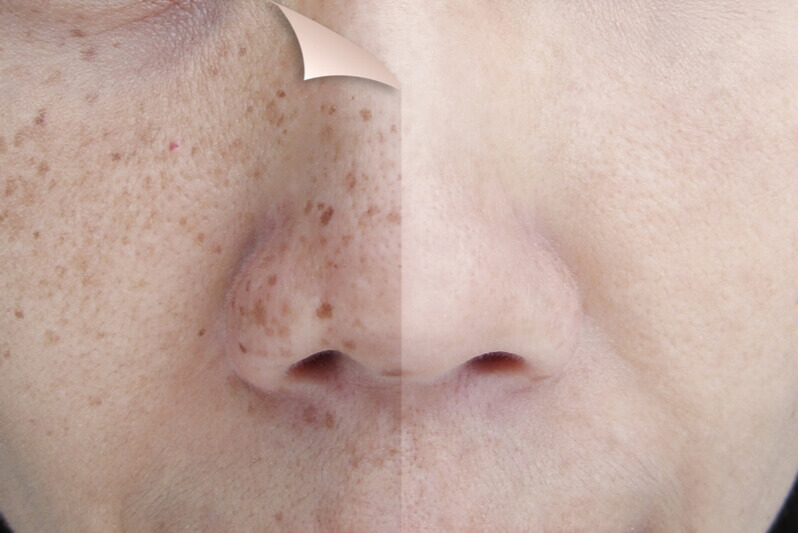 Pico Laser for Various Skin Concerns